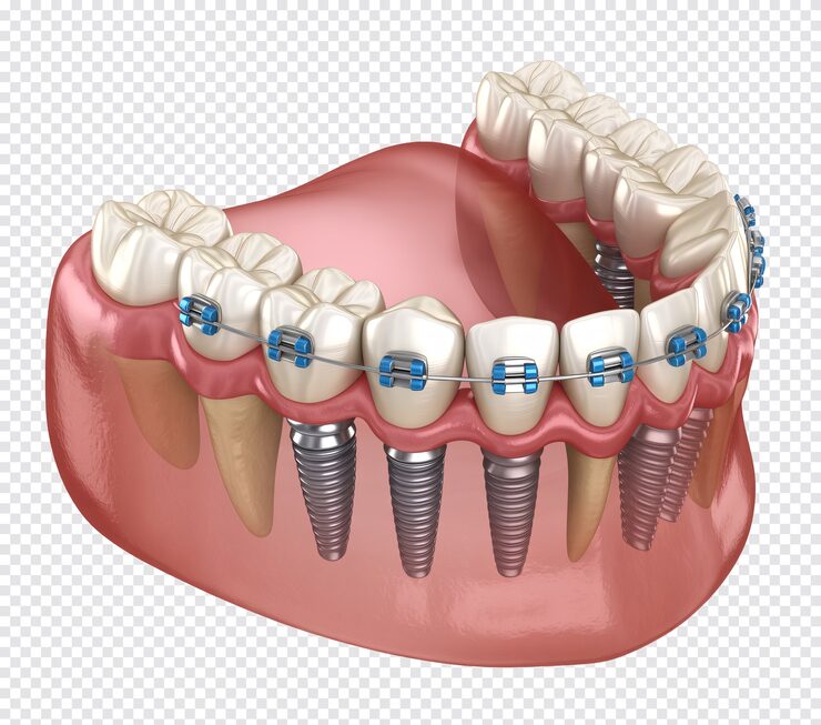 PSD 3d alt çene, diş i̇mplantları ve diş telleri ile şeffaf arka planda i̇zole edilmiş