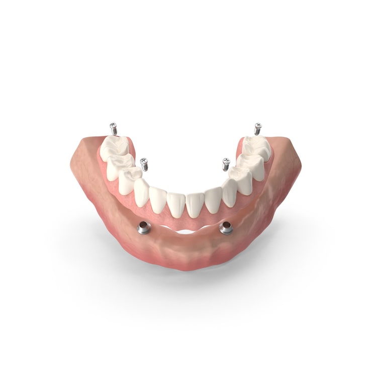 PSD dental i̇mplant destekli protez