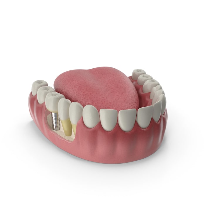 PSD diş implantı ve yapay dişlerin 3d modeli