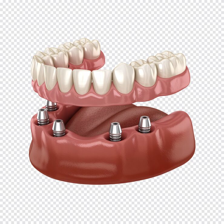 PSD şeffaf arka plan üzerinde izole edilmiş 3d dental implantlar ve tam protez